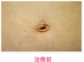 治療前