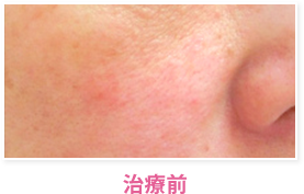 治療前