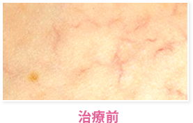 治療前