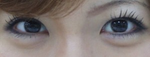 涙袋人気です。ヒアルロン酸による涙袋形成【症例写真あり】