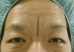 眉間の深すぎるしわ