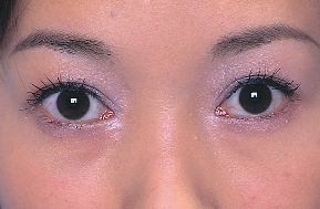目頭切開の手術前後写真
