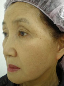 フェイスリフト手術・頬の脂肪吸引