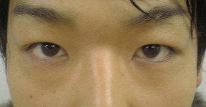 二重まぶた埋没法と脂肪除去（脱脂）