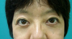 上まぶたのタルミ取り手術（ブローリフト）