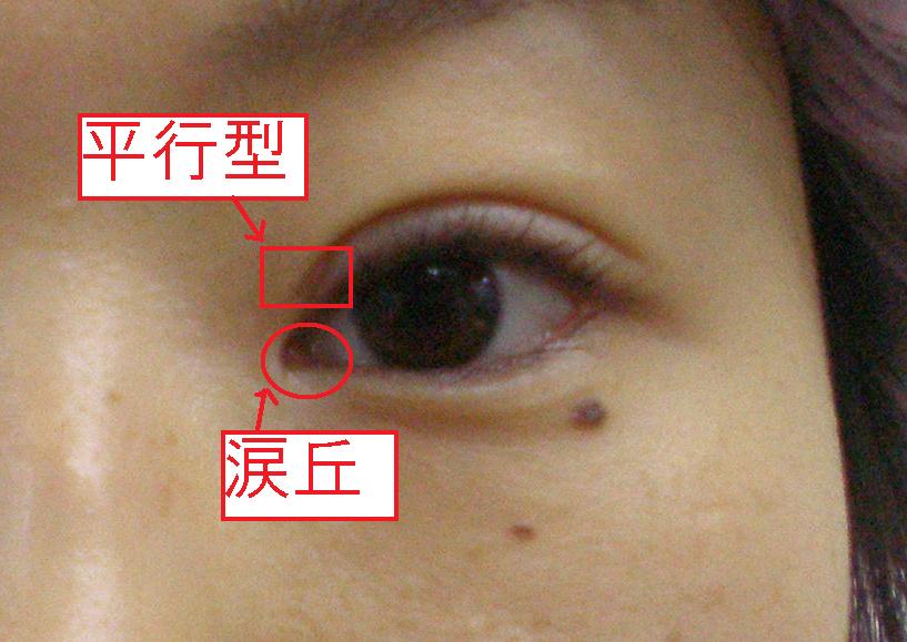 目頭切開手術【平行型に二重にする方法】