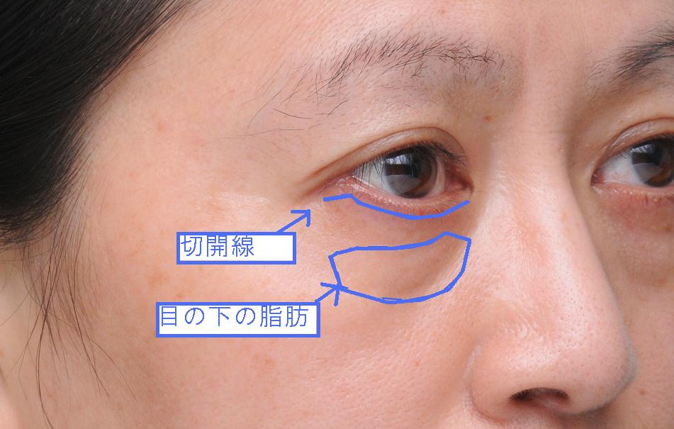 目の下のタルミ手術前 目の下のタルミ手術前