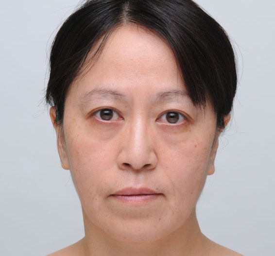 アンチエイジング前正面