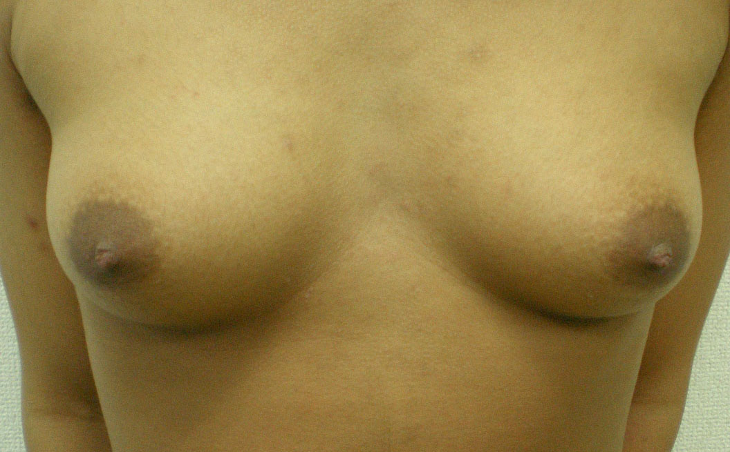 乳房切除前