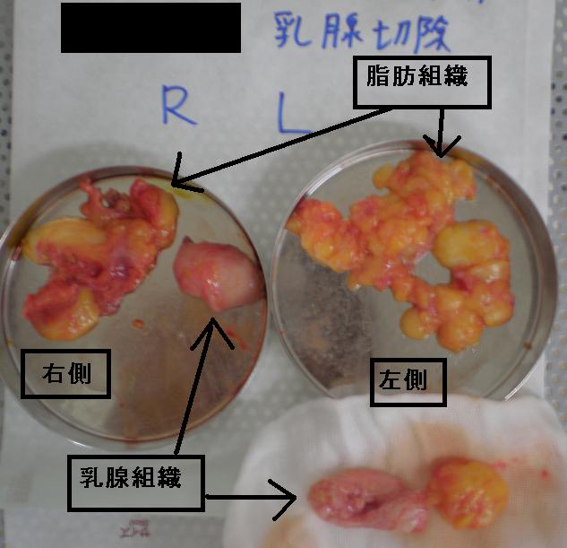 乳腺 脂肪組織 乳腺 脂肪組織