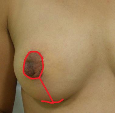 乳房挙上手術痕 乳房挙上手術痕