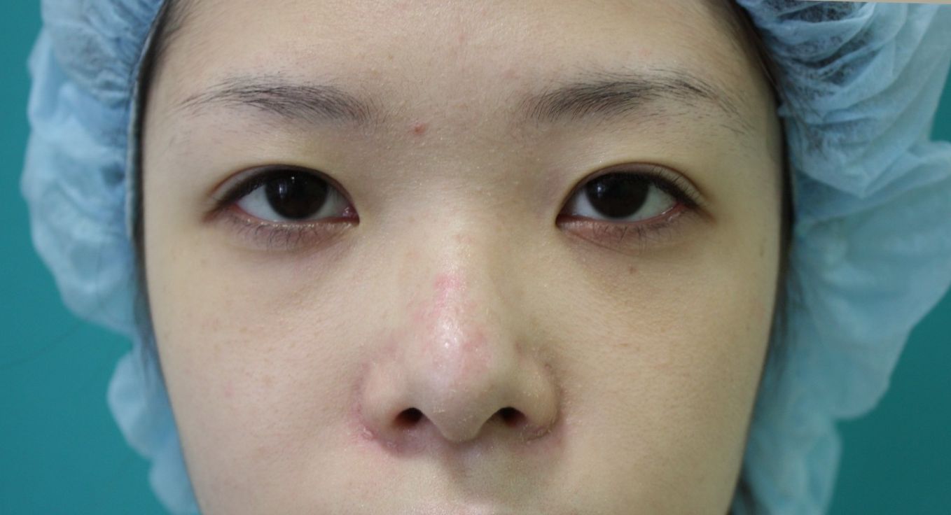 眼瞼下垂修正手術後2 眼瞼下垂修正手術後2