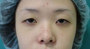 眼瞼下垂修正手術（目の開きを大きくする手術）