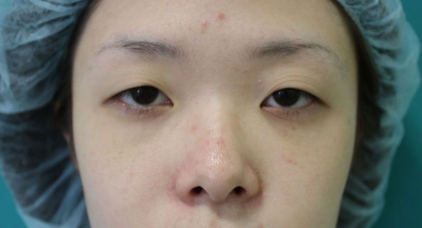 眼瞼下垂修正手術前 眼瞼下垂修正手術前