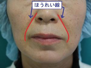 ほうれい線を消すプチ整形