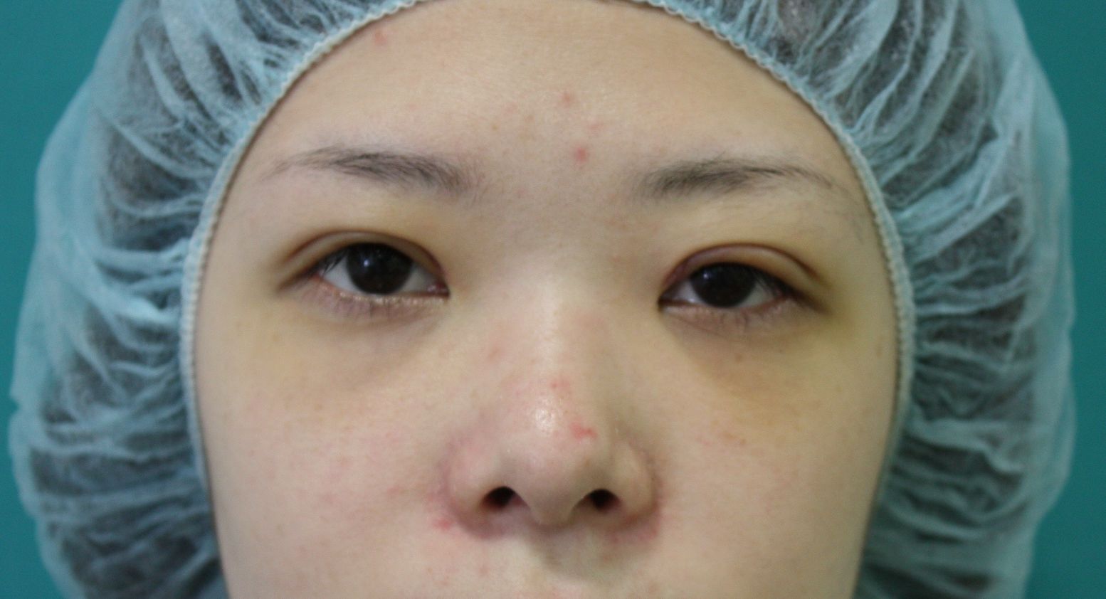 眼瞼下垂修正手術後1 眼瞼下垂修正手術後1