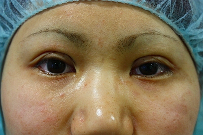 二重手術直後開 二重手術直後開
