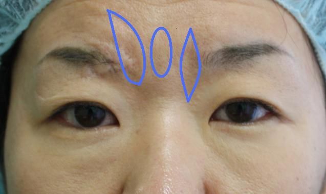 眉間しわ 眉間しわ