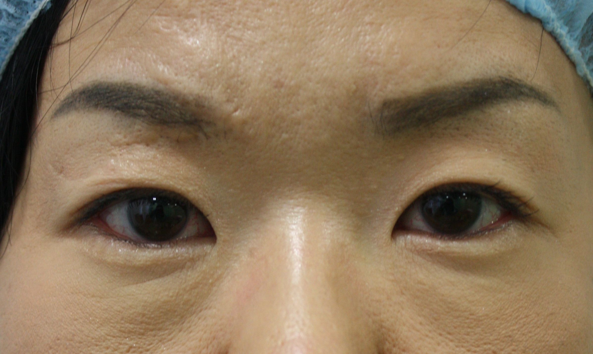 眉間施術後1 眉間施術後1