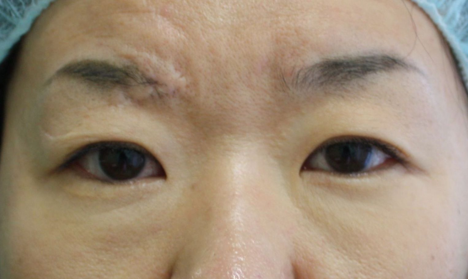 眉間施術前1