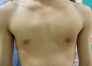 女性化乳房：真性女性化乳房のモニター