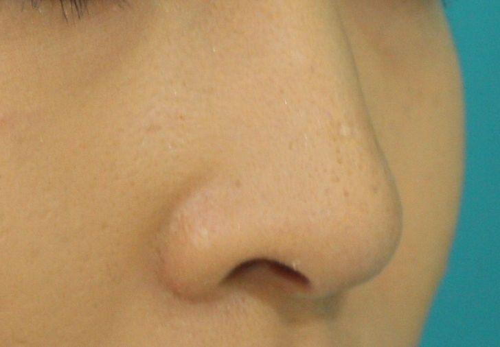 鼻プロテーゼ後1 鼻プロテーゼ後1