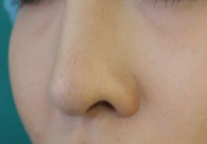 L字型プロテーゼの欠点
