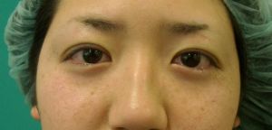 正月休みを利用しての二重手術はいかがですか？