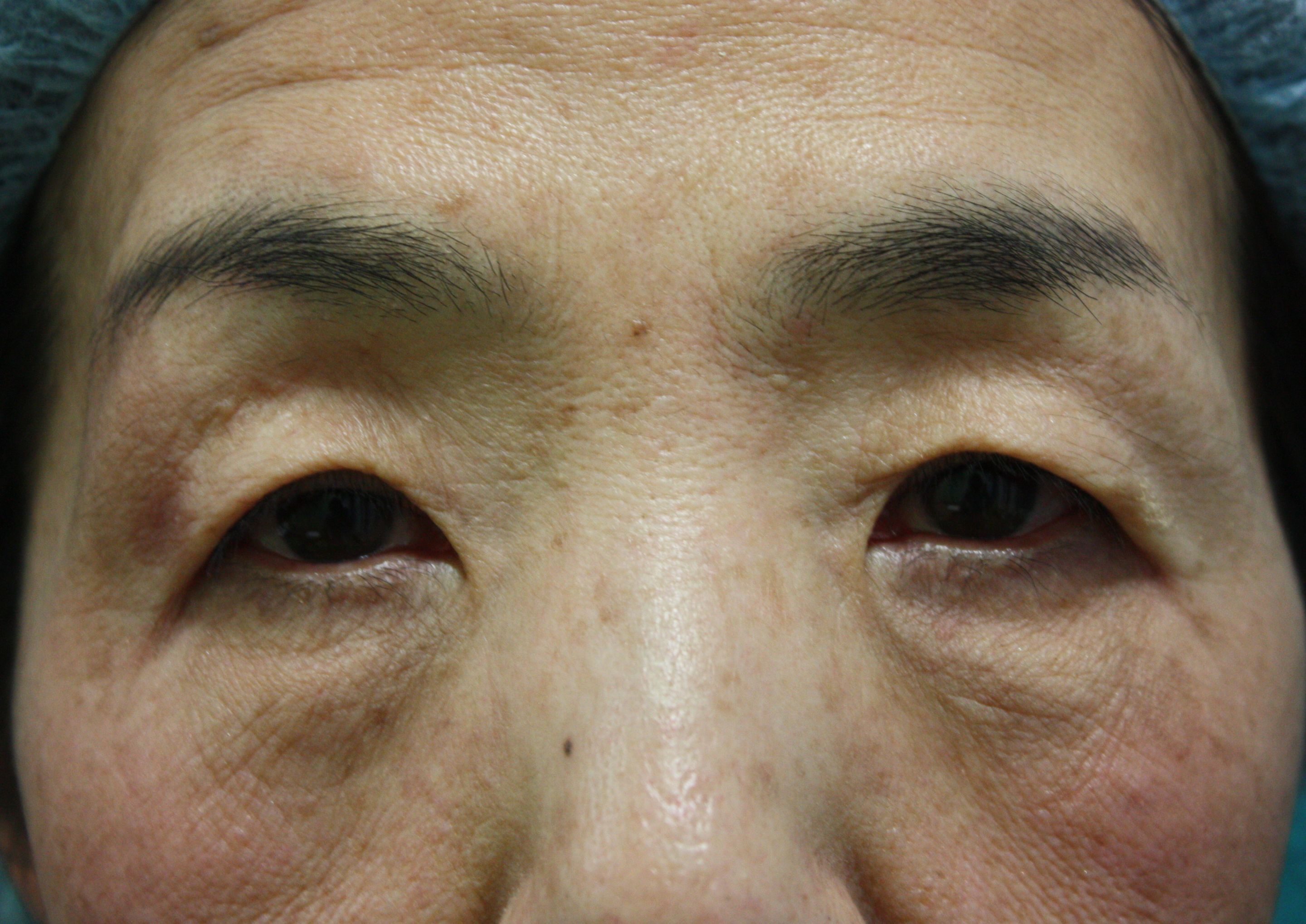 ブローリフト前 ブローリフト前