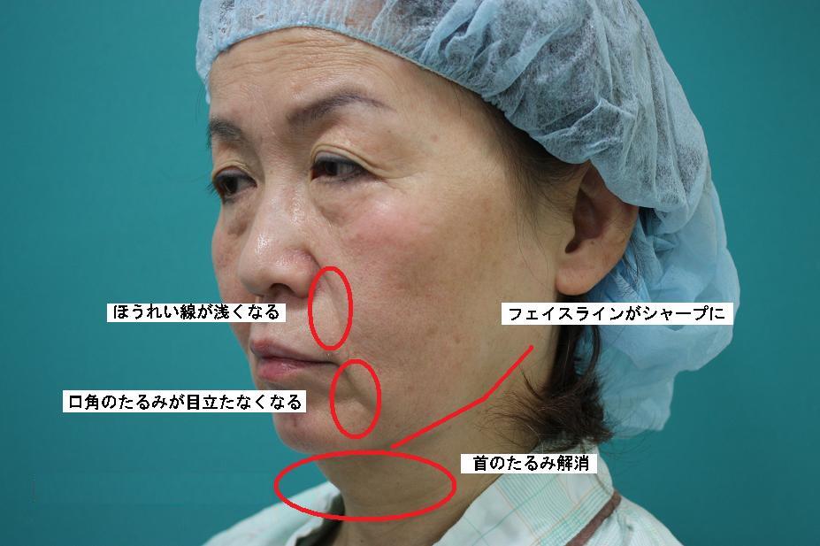若返りポイント 若返りポイント