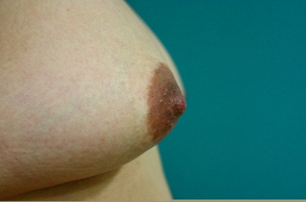 乳頭縮小再手術後 右 乳頭縮小再手術後 右