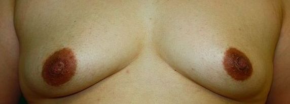 乳頭縮小再手術後 正面 乳頭縮小再手術後 正面
