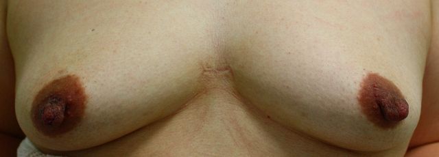 乳頭縮小手術前 正面 乳頭縮小手術前 正面