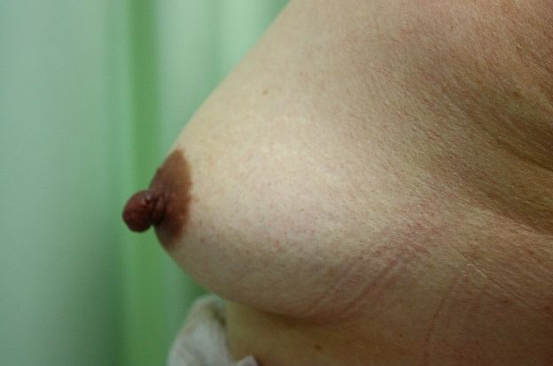乳頭縮小手術前 左 乳頭縮小手術前 左