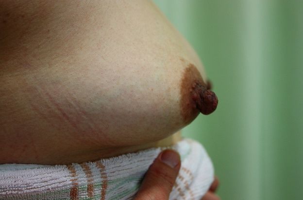 乳頭縮小手術前 右 乳頭縮小手術前 右
