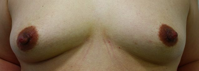 乳頭縮小手術後 正面 乳頭縮小手術後 正面