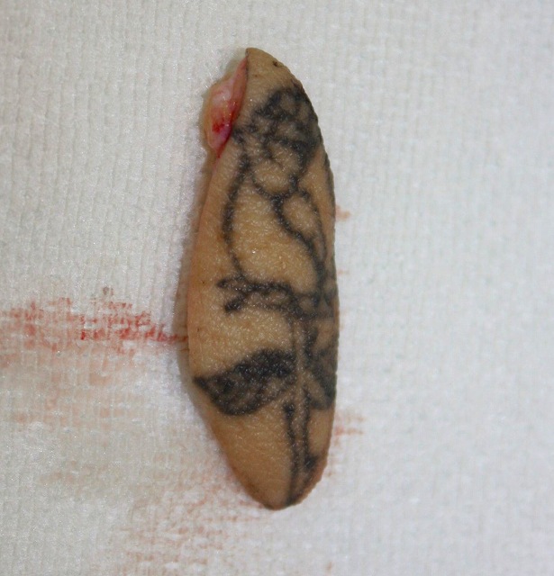 刺青除去 刺青除去