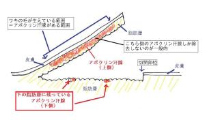 わきが手術について（弟2回）