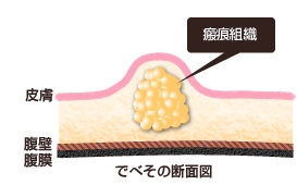 でべそイラスト