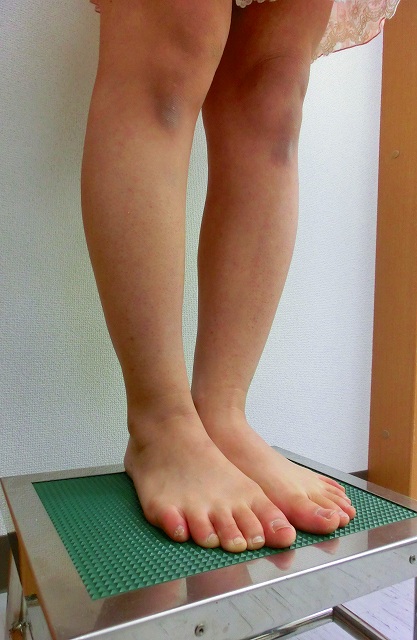 ふくらはぎボトックス治療後2 ふくらはぎボトックス治療後2