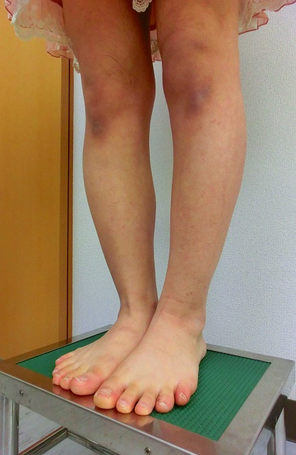 ふくらはぎボトックス治療後3 ふくらはぎボトックス治療後3