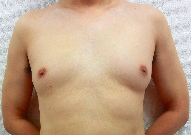 偽性女性化乳房B1 偽性女性化乳房B1