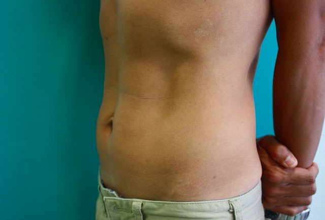 メソセラピー後2 メソセラピー後2