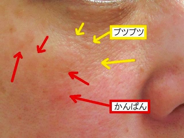 レーザートレニング治療前アップ2説明