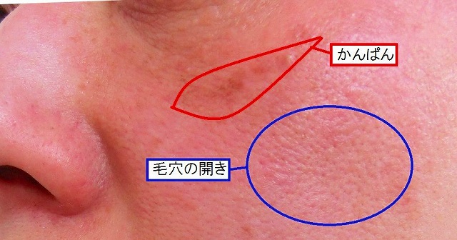 レーザートレニング治療前アップ１説明