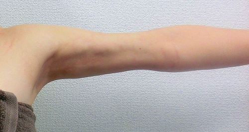 二の腕脂肪吸引後10 二の腕脂肪吸引後10