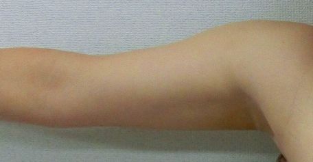 二の腕脂肪吸引前11 二の腕脂肪吸引前11