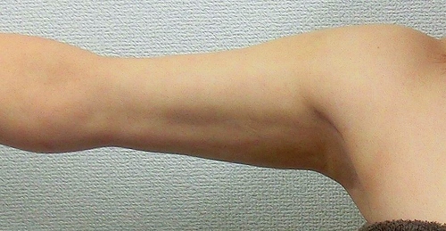 二の腕脂肪吸引後12 二の腕脂肪吸引後12
