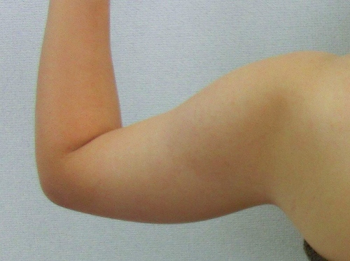 二の腕脂肪吸引前1 二の腕脂肪吸引前1
