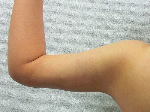 二の腕脂肪吸引後2 二の腕脂肪吸引後2